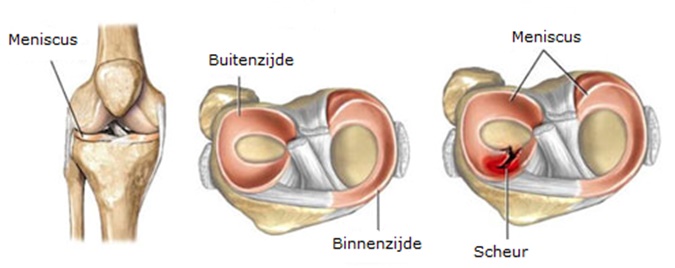 Plaatjes meniscus